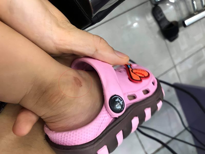 Vết thương lớn do ngã xe